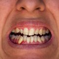Eestlaste hambad on kehvas seisus. Üllatav põhjus, miks hambaarsti juurde ei jõuta õigel ajal ja mis ei seisne rahas