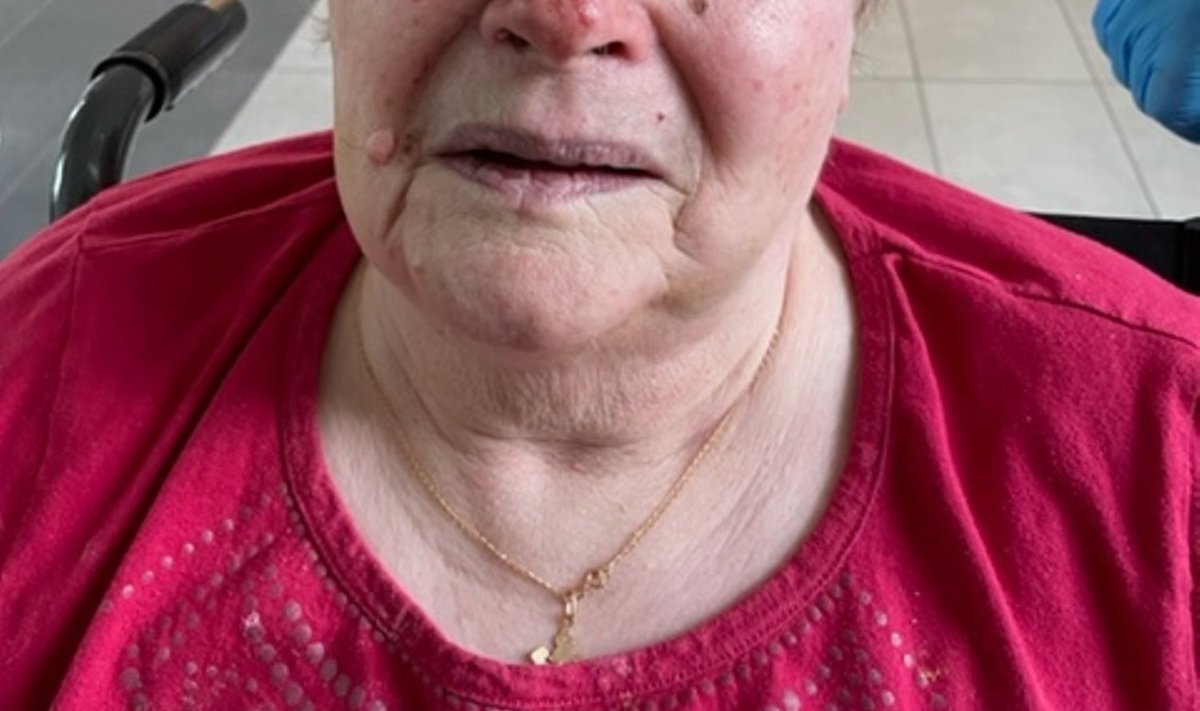РАЗБИТЫЙ НОС: По словам дочери, в доме престарелых Сирафиму В. еще и били. Cотрудники учреждения утверждают, что женщина поцарапала нос, когда укусила сиделку.