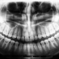 Hambaarst õpetab: mida teha, kui hammas on trauma tõttu katki läinud või suust välja tulnud