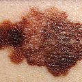 Kaasaegne tehnoloogia aitab melanoomi märgata varakult