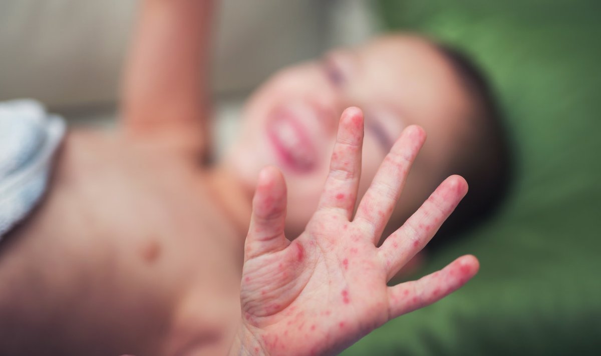 Leetritele väga iseloomulikuks tunnuseks on nahalööve peopesades.