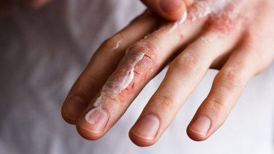 Õige käte ja jalgade hooldus võib ennetada tõsiseid terviseprobleeme. Vaata, kuidas seda just talvel õigesti teha