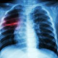 Täna on ülemaailmne tuberkuloosipäev: mis see üldse on ja kuidas mitte nakatuda?