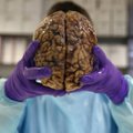 TÜ vähibioloogide osalusel tehtud avastus aitab Alzheimeri tõbe märksa varem diagnoosida