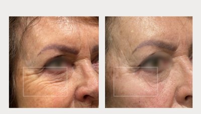 Silmaümbruspiirkond: enne ja pärast