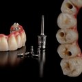Millised on hammaste proteesimise võimalused?