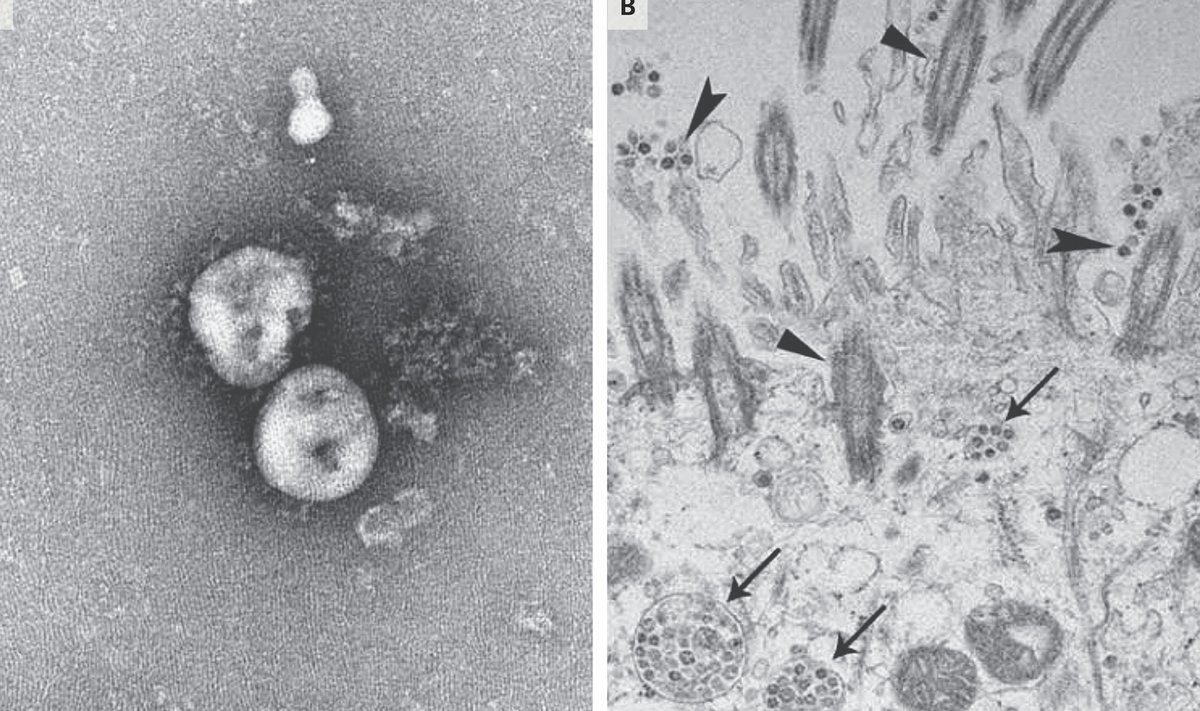 KURJA JUUR: Vasemal on näha 2019-nCoV nime saanud uus koroonaviirus elektronmikroskoobi all. Paremal on samad viirustekitajad pildistatuna inimese hingamisteede rakkudes.