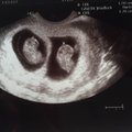 Kaksikute blogi: kuidas see üldse võimalik on, et ma rasedaks jäin! Ja kaksikud ka veel!