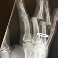 FOTOD | Rulalegend Tony Hawk oli sunnitud sõrmevigastuse pärast abielusõrmuse katki lõikama