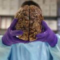 Hea uudis - uut Alzheimeri tõve ravimit testiti üliedukalt inimeste peal