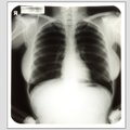 Haige poisike Tartus röntgenijärjekorras
