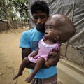 FOTOD: India arstid päästsid ligi meetriseks kasvanud peaümbermõõduga lapse
