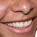 Рийгикогу принял закон, повышающий компенсации за стоматологическое лечение