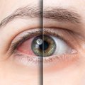 Silmad on kuivad või näed pimeduses väga halvasti? See on märk ühest kindlast vitamiini puudusest