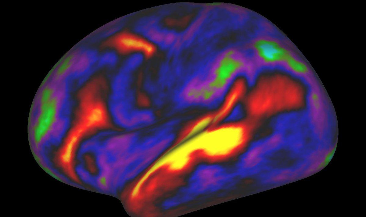 MRI-pilt, mis näitab inimese aju aktiivseid piirkondi lugude kuulamise ajal. 