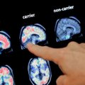 Dementsuse diagnoos vereanalüüsiga: Suurbritannias proovitakse uudseid Alzheimeri tõve teste