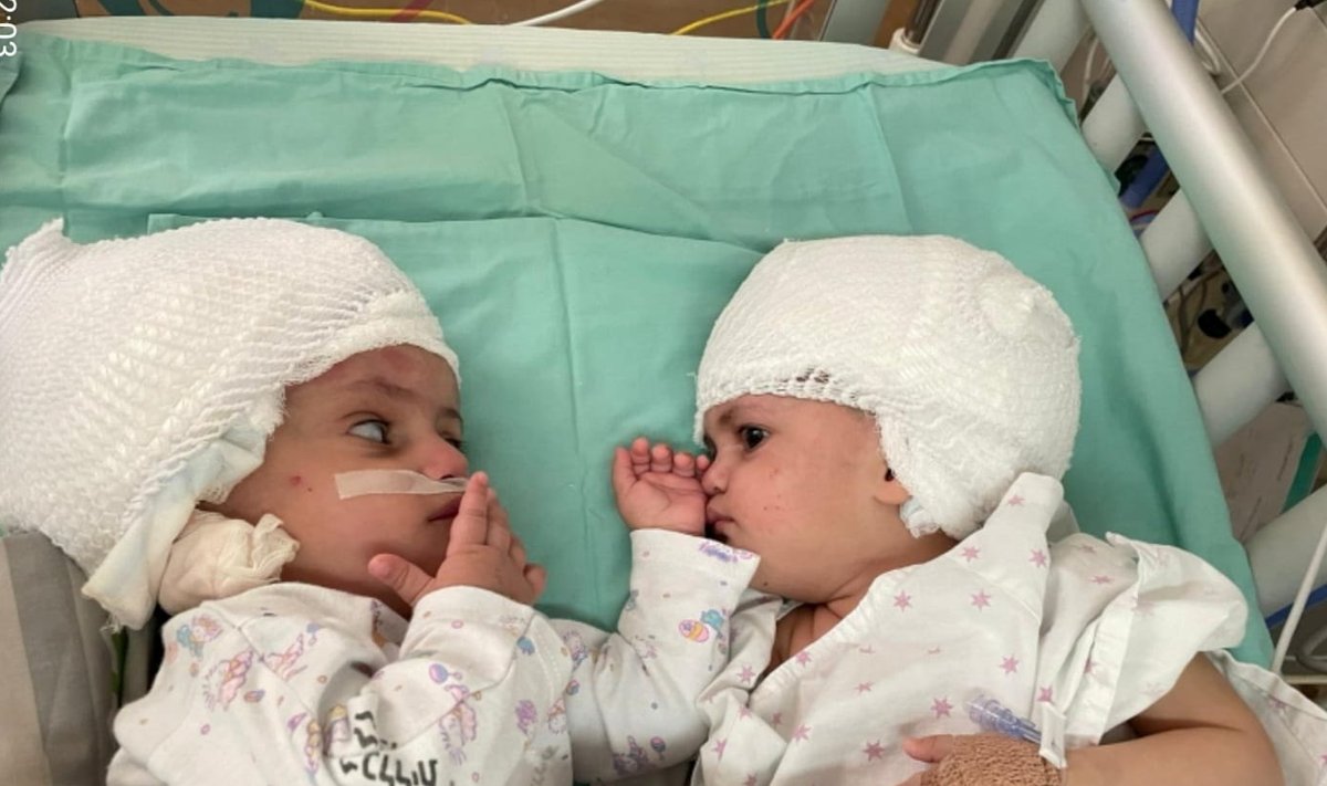 Бывшие сиамские близнецы из Израиля смотрят друг на друга после перенесенной редкой операции по разделению в медицинском центре Сорока, Беэр-Шева, 5 сентября 2021 года. Годовалые девочки, имена которых не разглашаются в СМИ, родились соединенными затылками