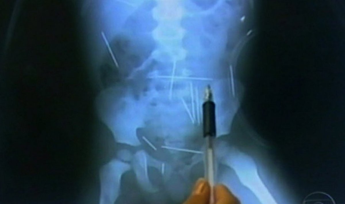 In this frame taken from a TV Globo video, a person points at a X-ray of a 2-year-old boy showing needles inside his body in a hospital in Ibotirama, northern Brazil, Tuesday, Dec. 15, 2009. A 2-year-old Brazilian boy has as many as 50 metal sewing needles inside his body and a doctor treating the boy said they were apparently stuck there one by one. (AP Photo/Agencia O Globo) / SCANPIX Code: 436