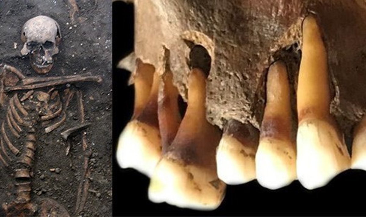 Vasakul: herpest põdenud täiskasvanud Cambridge'i mehe skelett 14. sajandist. Foto: Cambridge'i ülikooli arheoloogiaüksus. Paremal: piipu suitsetanud hollandlase hambad 17. sajandist. Teadlased eraldasid herpese DNA tema hambajuurtest.