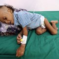 Abiorganisatsioon: Jeemenis võib olla nälga surnud 85 000 last