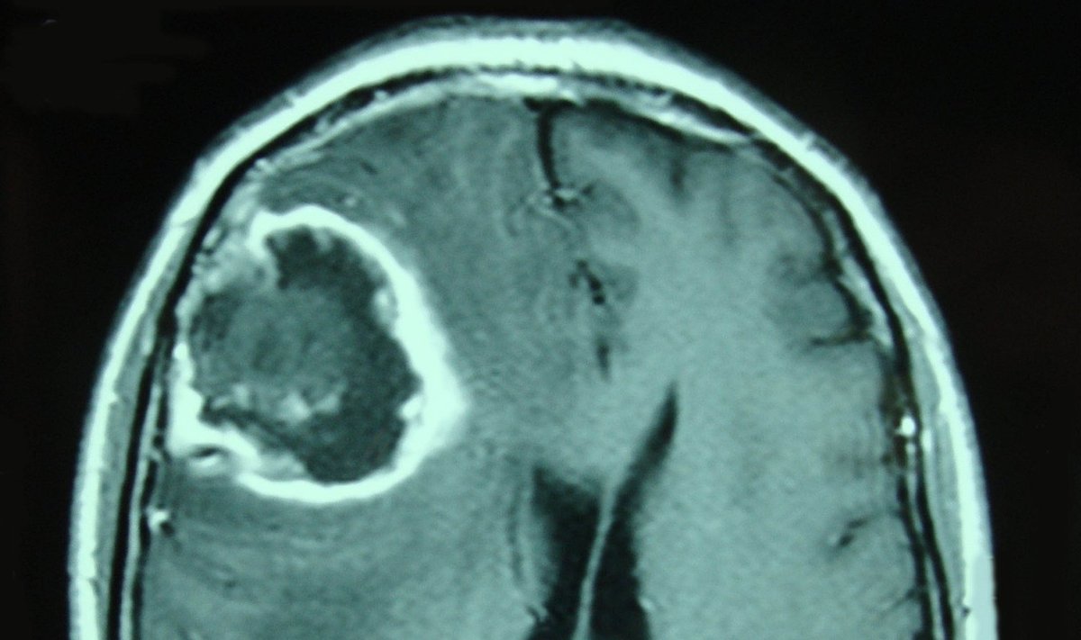 Agressiivne ajukasvaja multiformne glioblastoom. (Foto: Wikimedia Commons)