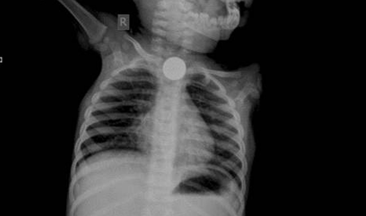Röntgenipilt: laps on patarei alla neelanud.
