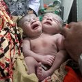 Bangladeshis sündis kahe peaga beebi