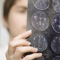 Arstid pidasid naise ajus elutsenud paelussi kasvajaks