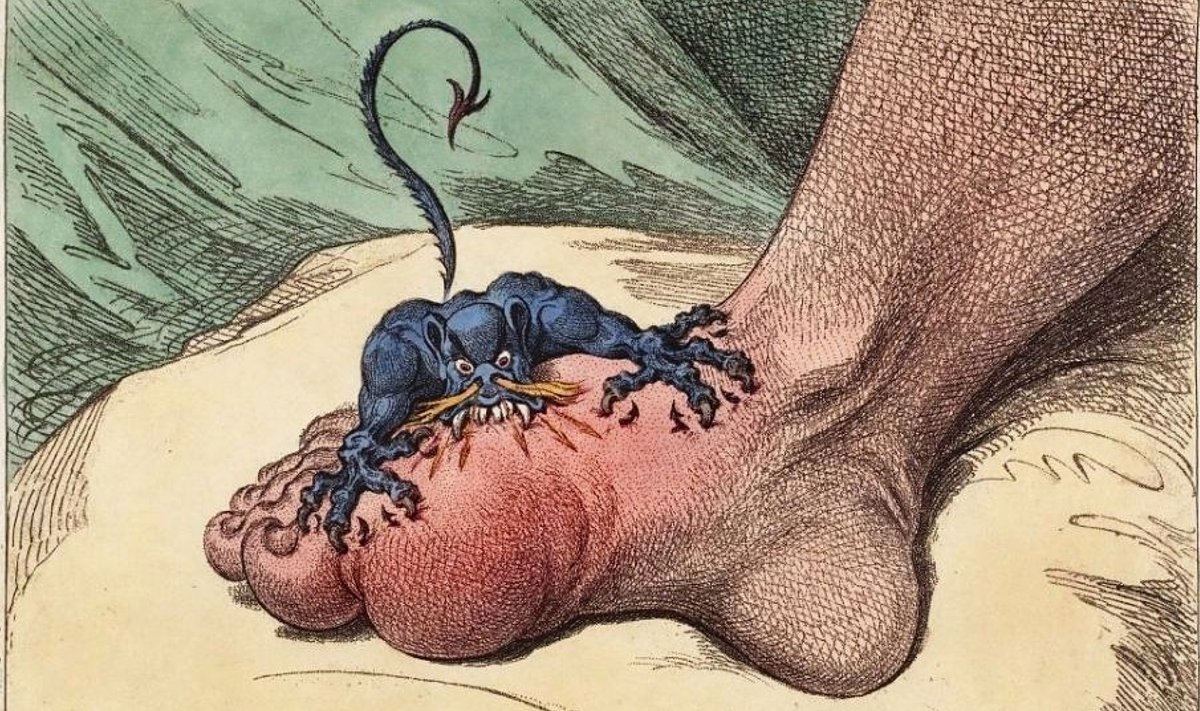18. sajandi illustratsioon näitab põletikulisi liigeseid tekitava podagra valusid. Haigus väljendub tihti just suure varba liigese põletikus ja paistetuses