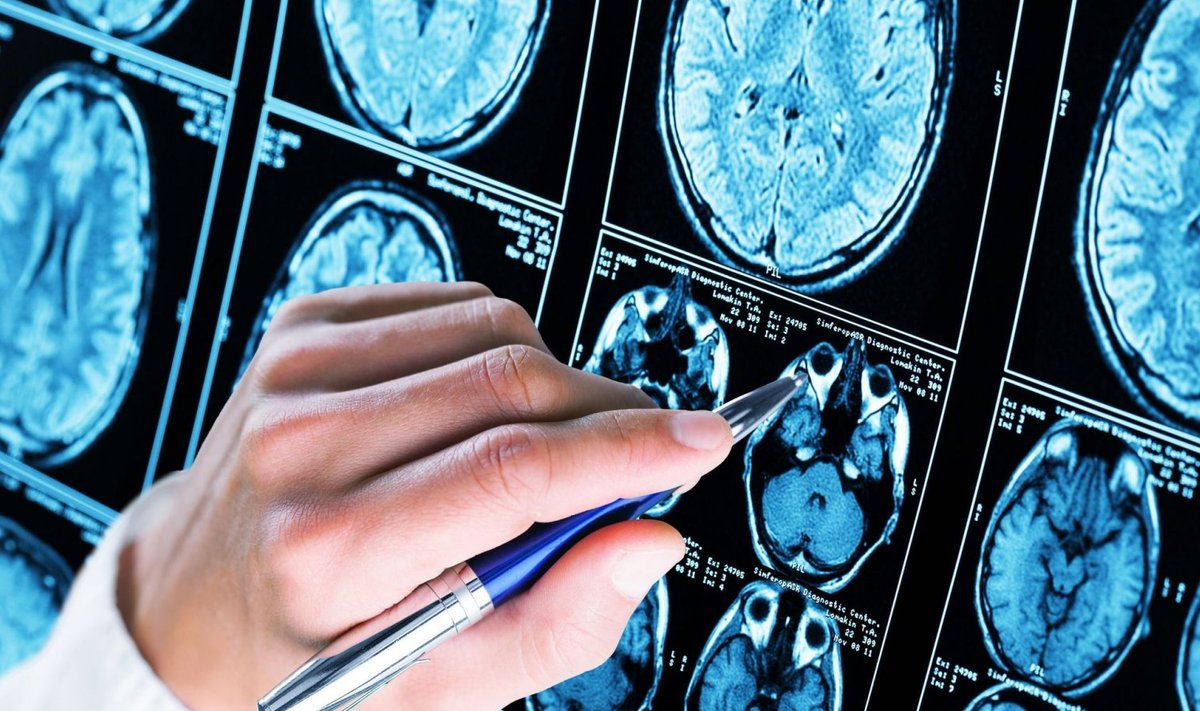 Tau-valkude kogunemine ajusse on Alzheimeriga rohkem seotud kui seni arvati