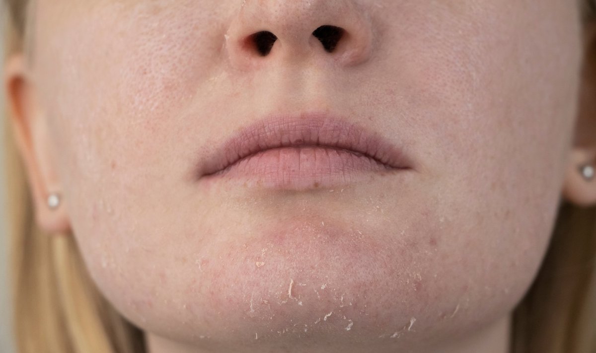 Kuiva naha sümptomid on karedus, sügelus, ketendus ning raskematel juhtudel isegi naha lõhenemine.