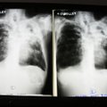 В прошлом году в Эстонии выявлено 214 случаев заболевания туберкулезом