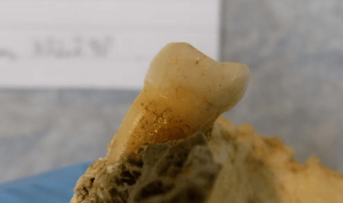 Üks hammastest, millest leiti bakterite DNA-d.