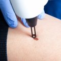 Salakaval melanoom: millal tuleb oma sünnimärki või kahtlast uusmoodustist nahal arstile näidata?