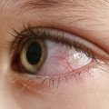 Silmaarst hoiatab: vähemärgatavad muutused silmas võivad olla märgid diabeedist või isegi vähist