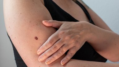 Nahavähk on nähtav! Eesti Vähiliit: viimase 10 aasta vältel on haigestumus melanoomi Eestis kasvanud lausa poole võrra