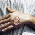 Matrjoška-viiruse tekitatud leišmanioos - pesitseb inimest ründavat kärbest kurnava parasiidi sees