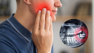 Советы эстонского стоматолога: почему зуб мудрости иногда проще удалить, чем лечить