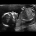 Parim ultraheliVIDEO: Vaata ja imesta, millega see tita oma ema kõhus hakkama saab!