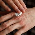 Kuidas ravida? Haigus, mille kulgu raskendavad stress ja suur väsimus ja mille käes kannatab üle 43 000 eestlase