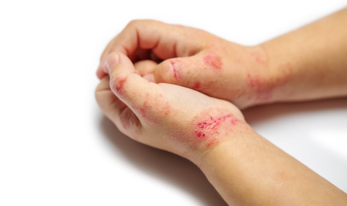 Atoopilise dermatiidiga käed