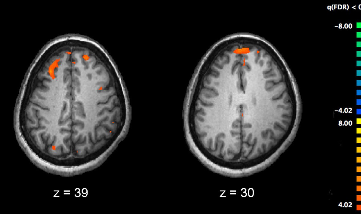 Magnetresonantspildid ja teised aju pildistamise tehnoloogiad võimaldavad teadlastel uurida skisofreeniadiagnoosiga inimeste ajuaktiivsust. Antud foto näitab oranži värviga, millised ajupiirkonnad olid skisofreeniadiagnoosiga inimestel vähemaktiivsed.