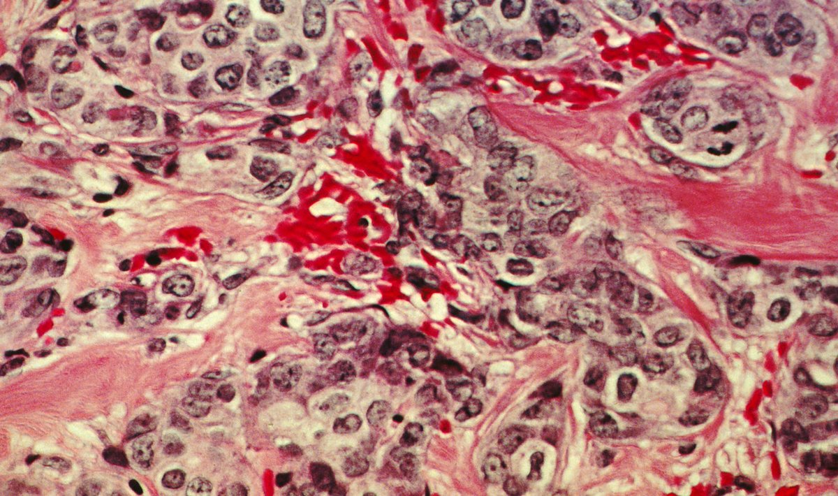 Rinnavähi rakud suurendatuna (Foto: Wikimedia Commons / USA riiklik vähiinstituut, dr Cecil Fox)
