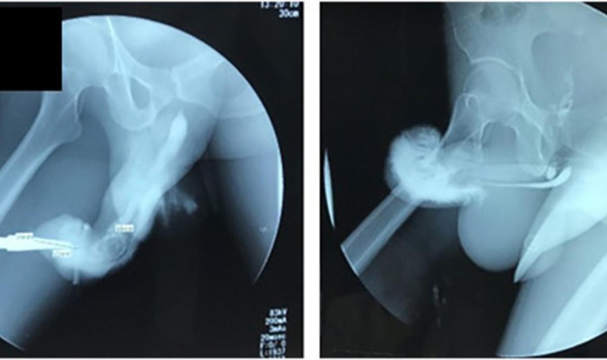 Indoneesia arstide röntgeniülesvõtted peenise vigastusest