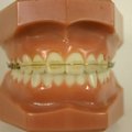 Kiirvideo: kuidas hambaklambrid hambumust reaalselt mõjutavad
