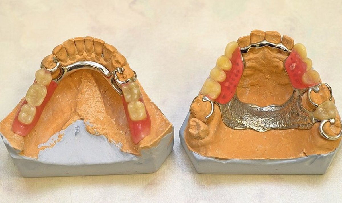 Hambaarstid soovitavad eelistada metallkarkassiga proteese.