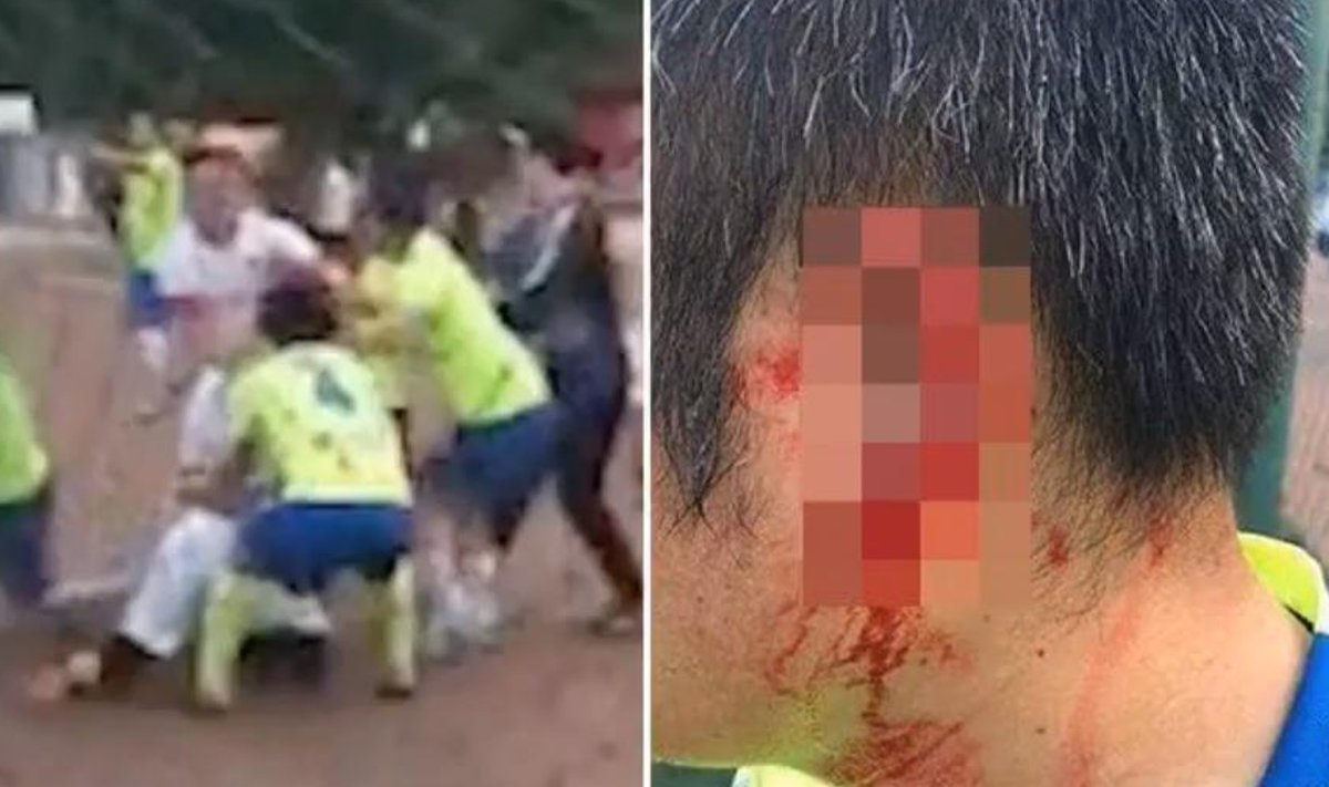 Hiinas hammustas kaasmängija jalgpalluri kõrva küljest ära suure tüki.