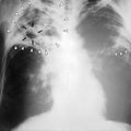 Eestis haigestus mullu tuberkuloosi 175 inimest