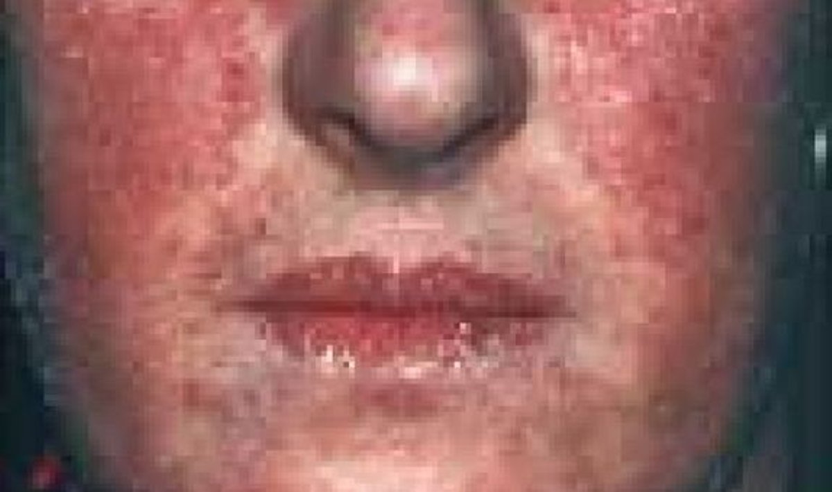 Roosvinnide puhul tekib põskedel ja ninal punetus. 