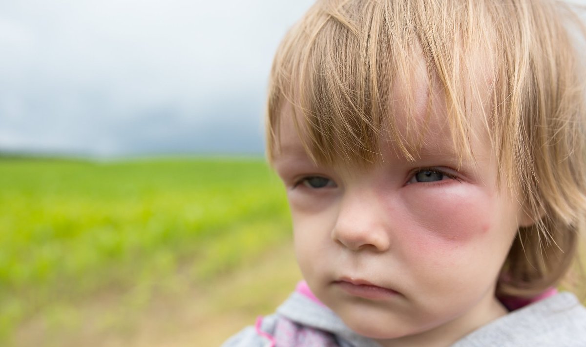 Allergiline reaktsioon võib ulatuda paiksest ärritusest nahal kuni eluohtliku anafülaktilise šokini.